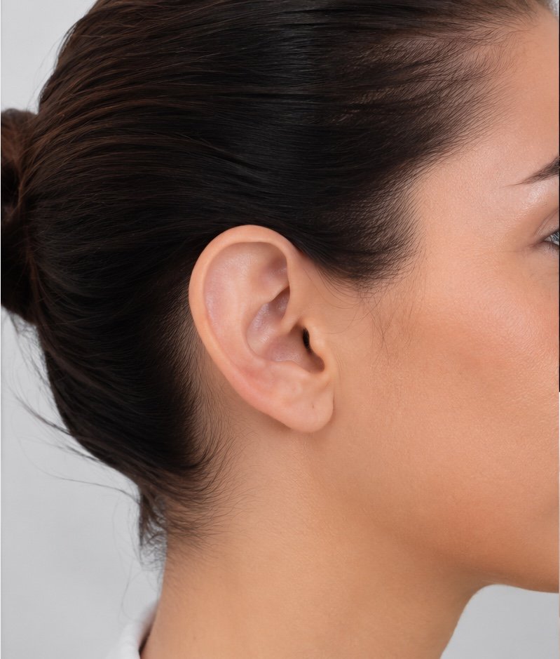 otoplastia